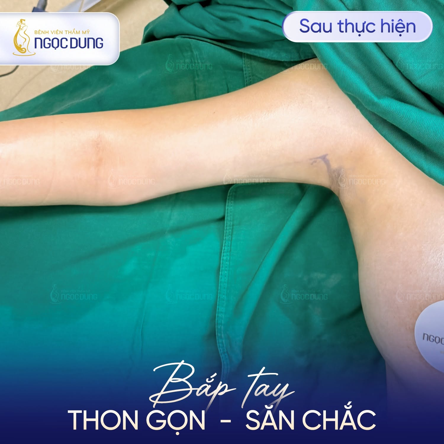 Có nên hút mỡ bắp tay không? Giải đáp chi tiết, đầy đủ 20 Dịch vụ giảm mỡ bắp tay an toàn tại Bệnh Viện Thẩm Mỹ Ngọc Dung