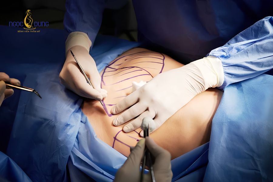 Hút mỡ bụng giá bao nhiêu tiền? Bảng giá cập nhật mới 13 Hậu quả biến chứng lồi lõm, nhiễm trùng do phẫu thuật hút mỡ giá rẻ tại các spa chui
