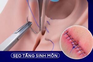 Hình thái sẹo lồi gồ cao trên bề mặt niêm mạc tầng sinh môn do tăng sinh mô xơ bẩm sinh hoặc kích ứng