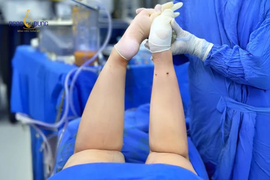 Chi phí hút mỡ bắp chân bao nhiêu? Bảng giá mới nhất 12 Hút mỡ bắp chân sử dụng ống hút chuyên dụng loại bỏ mỡ thừa qua đường rạch siêu nhỏ