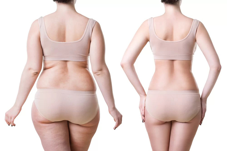 Hút mỡ là gì? Quy trình, phương pháp và chi phí ra sao? 10 Hút mỡ giúp cải thiện đường nét cơ thể cân đối và thon gọn