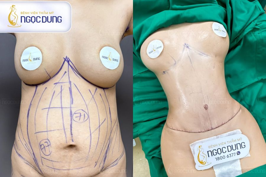 Hút mỡ là gì? Quy trình, phương pháp và chi phí ra sao? 12 Kỹ thuật hút mỡ trợ rung PAL hỗ trợ thao tác nhẹ nhàng trên vùng mỡ diện tích lớn