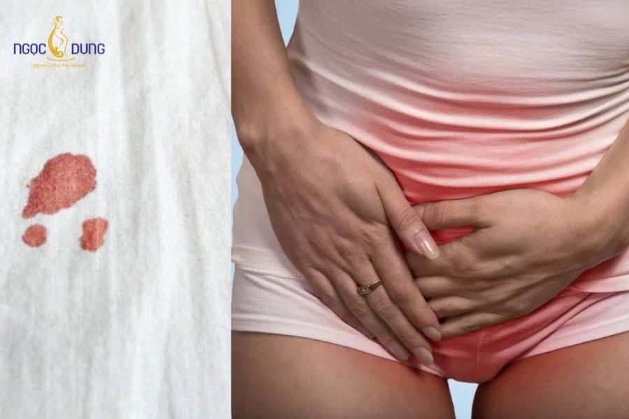 Rách màng trinh chảy máu màu gì? Giải đáp chi tiết 6 Máu chảy khi rách màng trinh thường có màu đỏ tươi do các mao mạch nhỏ tại cửa âm đạo bị tác động