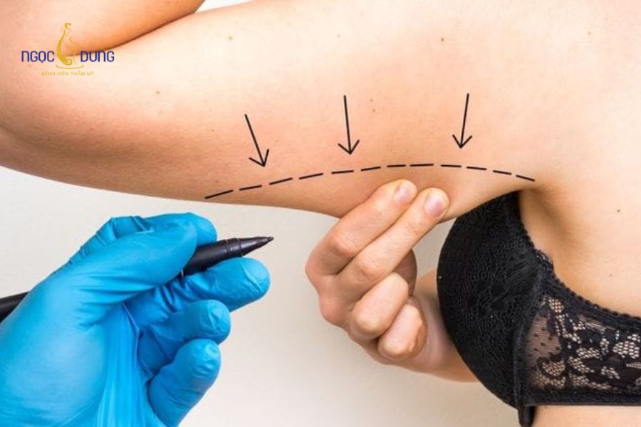 Hút mỡ bắp tay giá bao nhiêu tiền? Bảng giá mới nhất 14 Mỗi công nghệ hóa lỏng mỡ sẽ có mức giá khác nhau tương ứng với hiệu quả mang lại