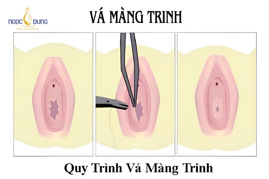 Chi phí vá màng trinh bao nhiêu tiền? Bảng giá 2026 11 Mức độ rộng và độ co rút của vết rách màng trinh quyết định đến độ phức tạp khi khâu vá