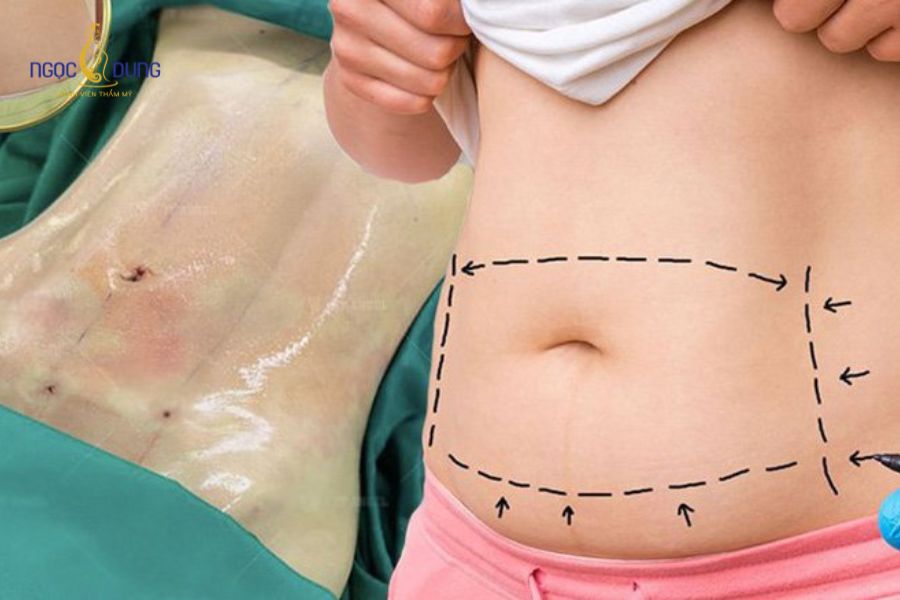 Hút mỡ bụng có để lại sẹo không? Giải đáp chuyên môn 8 Mức độ sẹo phụ thuộc lớn vào phương pháp thực hiện, tay nghề bác sĩ và cơ địa lành thương của khách hàng
