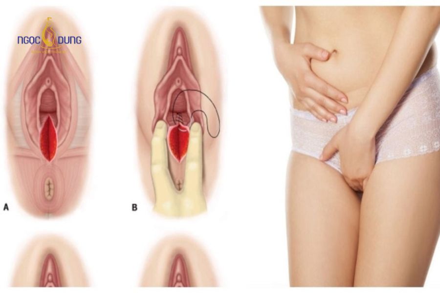 Thu hẹp tầng sinh môn: Có nên làm không? Quy trình 10 Những ảnh hưởng tiêu cực về mặt chức năng sinh lý khi mô tầng sinh môn bị giãn chùng