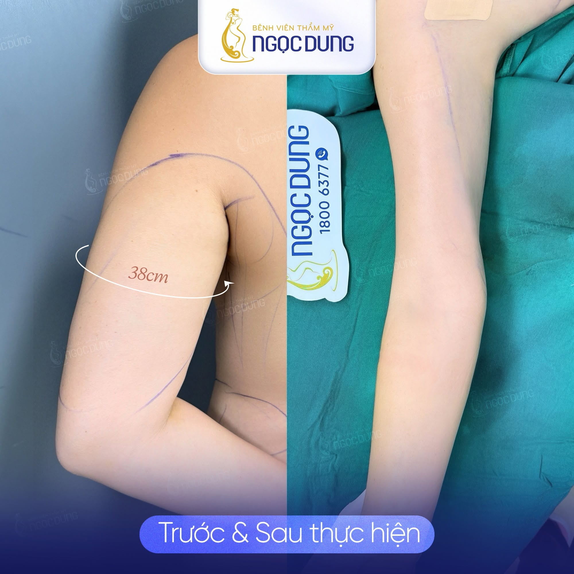 Hút mỡ bắp tay giá bao nhiêu tiền? Bảng giá mới nhất 11 Quy trình báo giá minh bạch tại bệnh viện uy tín giúp khách hàng an tâm thực hiện phẫu thuật