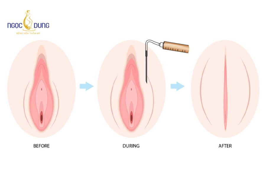 Tiêm filler vùng kín: Giải pháp thẩm mỹ an toàn y khoa 18 Quy trình tiêm filler vùng kín chuẩn y khoa cho khách hàng yên tâm khi thực hiện