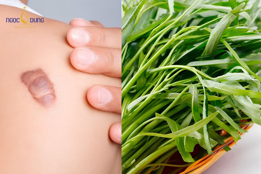 Hút mỡ bắp tay kiêng ăn gì để nhanh hồi phục, không sẹo 7 Rau muống thúc đẩy tăng sinh mô xơ quá mức tại vết thương hở, dễ dẫn đến hiện tượng sẹo lồi