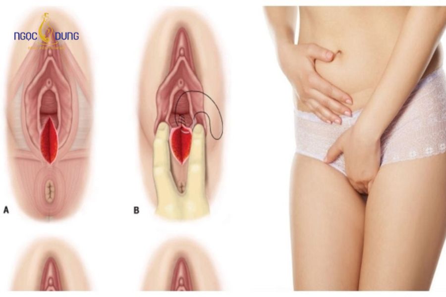 Vết khâu tầng sinh môn bị sưng mủ: Triệu chứng và xử lý 9 Sản phụ cần chủ động nhận biết sớm các biểu hiện sưng đỏ, đau nhức bất thường tại vết khâu tầng sinh môn
