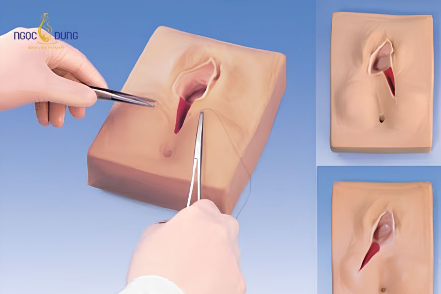 Khâu thẩm mỹ tầng sinh môn giá bao nhiêu? Bảng giá mới 14 Sơ đồ cấu tạo ba tầng cân cơ vùng tầng sinh môn đóng vai trò nâng đỡ cơ quan vùng chậu