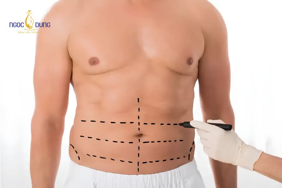 Hút mỡ bụng cho nam giới: Tạo hình thành bụng săn chắc 11 Tạo hình thành bụng nam giới hướng đến tiêu chuẩn bụng phẳng, săn chắc và lộ rõ rãnh cơ