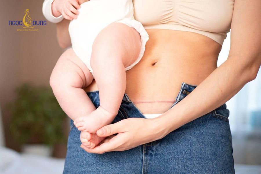 Có nên hút mỡ bụng sau sinh không? Giải đáp chi tiết 13 Thời điểm thích hợp nhất để hút mỡ bụng thường dao động từ 6 đến 12 tháng sau khi sinh