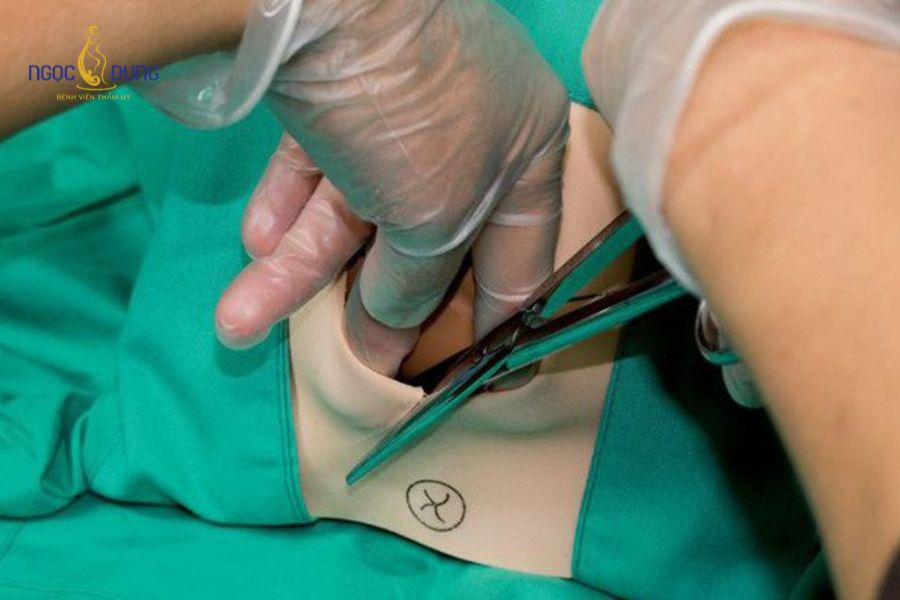 Cách rặn để hỗ trợ hạn chế rạch tầng sinh môn khi sinh thường 11 Thủ thuật cắt tầng sinh môn hỗ trợ giải phóng thai nhi nhanh chóng trong các ca sinh khó