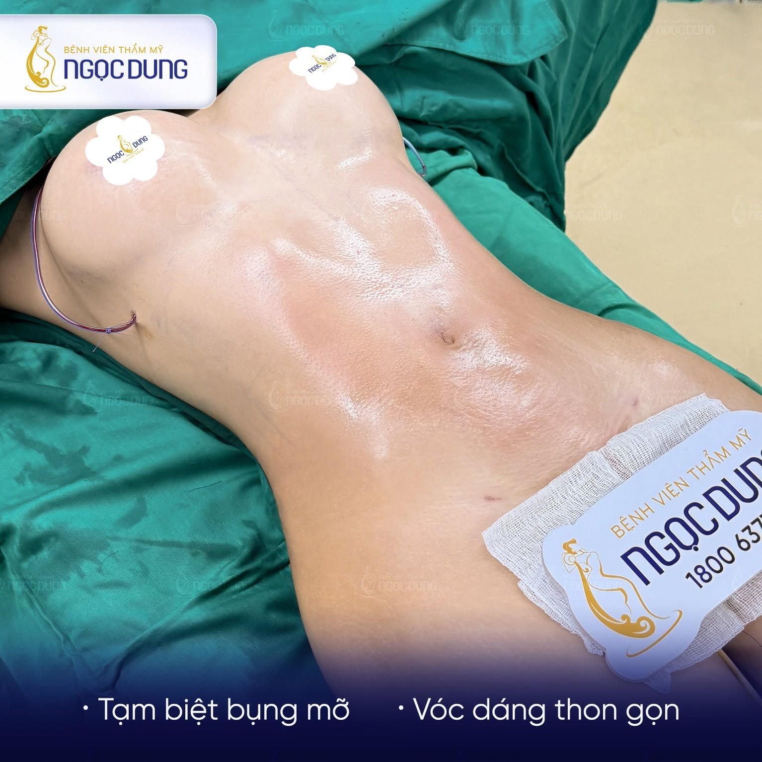 Hướng dẫn chăm sóc sau hút mỡ bụng, nhanh hồi phục 16 Tuân thủ hướng dẫn hậu phẫu từ bác sĩ là chìa khóa quyết định tính thẩm mỹ và độ an toàn
