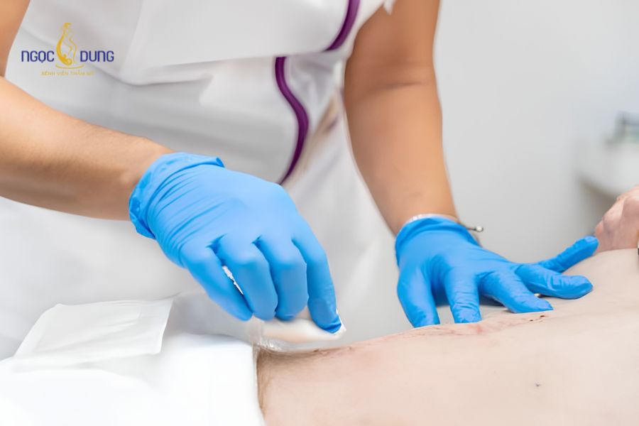 Hướng dẫn chăm sóc sau hút mỡ bụng, nhanh hồi phục 11 Vệ sinh vết mổ bằng nước muối sinh lý đúng chuẩn Y khoa tại nhà