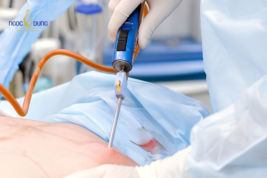 Hút mỡ có giảm cân không? Chuyên gia giải đáp chi tiết 11 Việc tuân thủ ngưỡng thể tích mỡ an toàn là quy định y khoa bắt buộc trong phẫu thuật