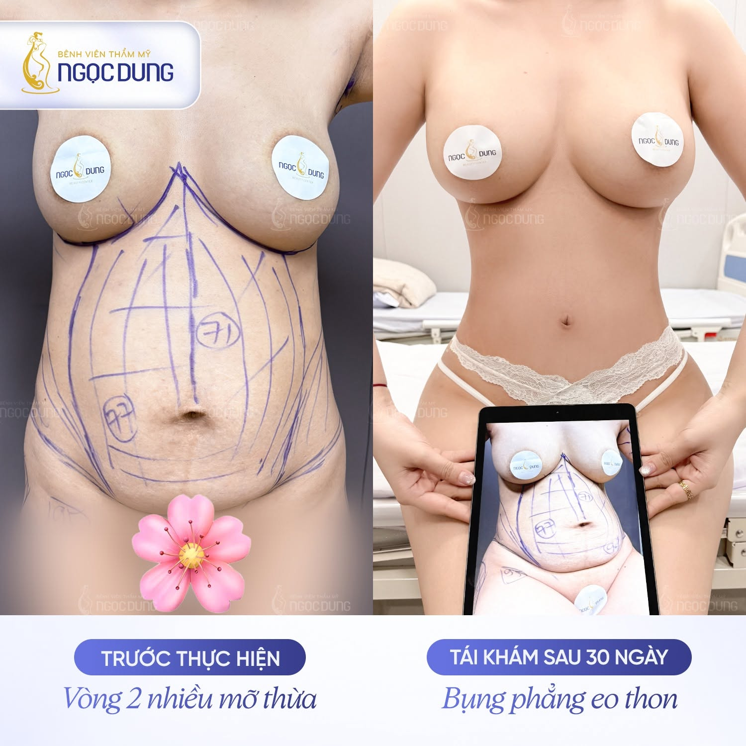 Hướng dẫn chăm sóc sau hút mỡ bụng, nhanh hồi phục 14 Vòng bụng săn chắc và lộ rõ đường nét thẩm mỹ sau 1 tháng hậu phẫu