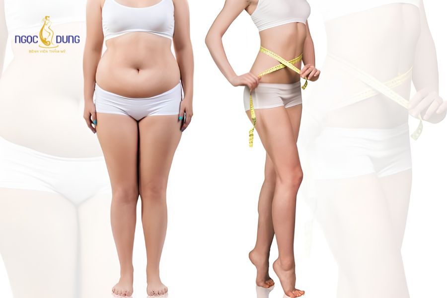 Hút mỡ có giảm cân không? Chuyên gia giải đáp chi tiết 12 Xác định đúng nhu cầu giúp bạn lựa chọn phương pháp cải thiện vóc dáng phù hợp